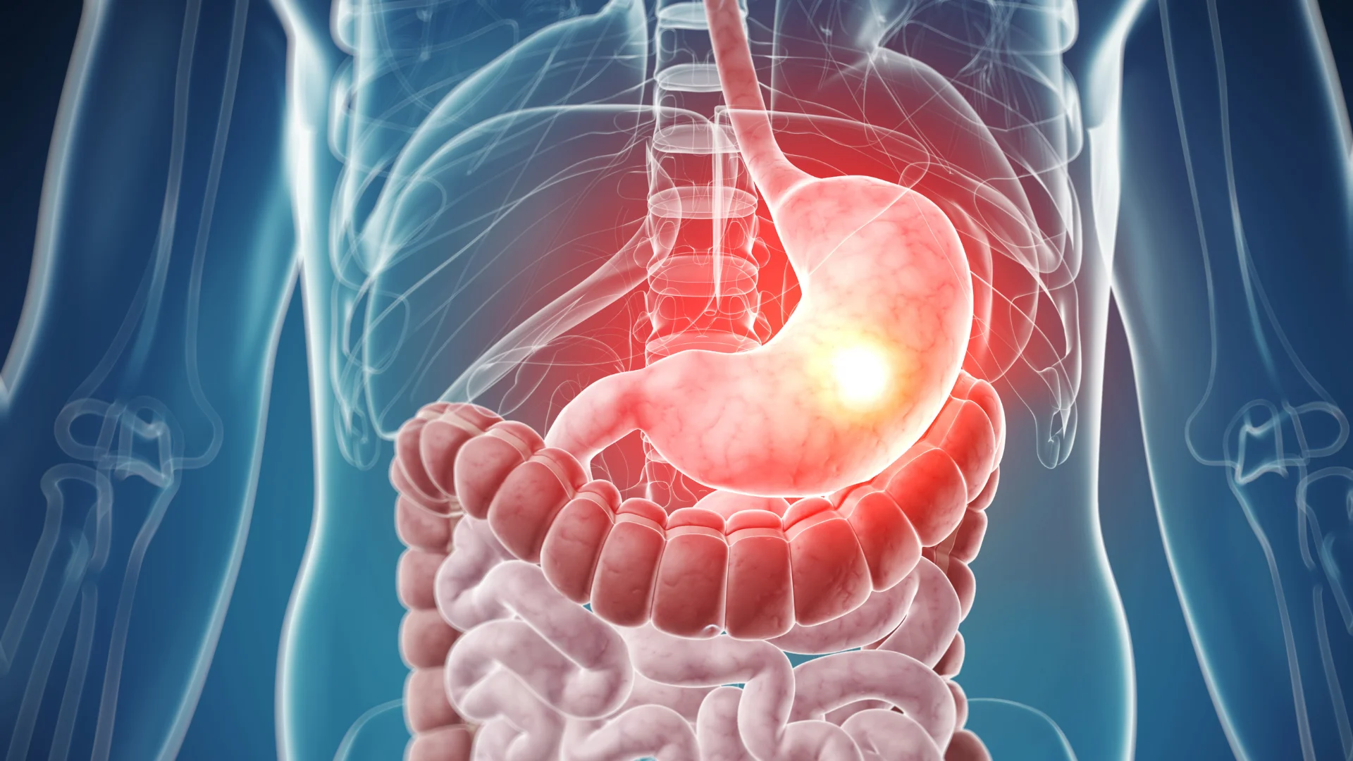 Stomach Cancer